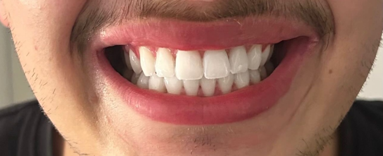 Client après blanchiment dentaire professionnel